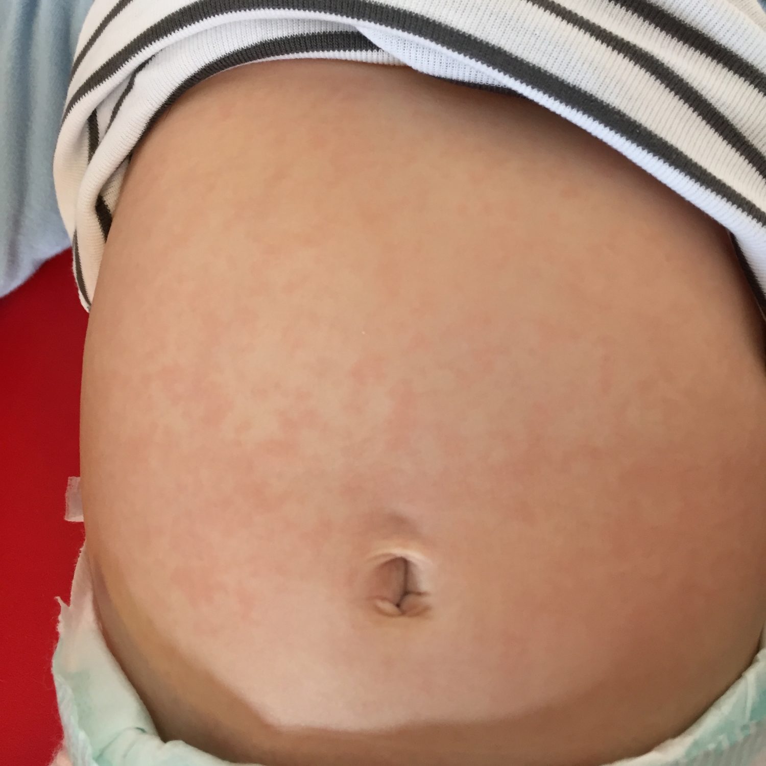 Kann Man 3 Tage Fieber öfter Bekommen 3-Tage-Fieber (Exanthema subitum) - Kinderarzt Prien